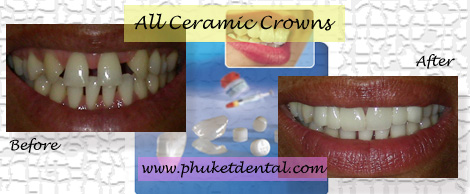 All Ceramic crowns/Phuket Dental Clinic